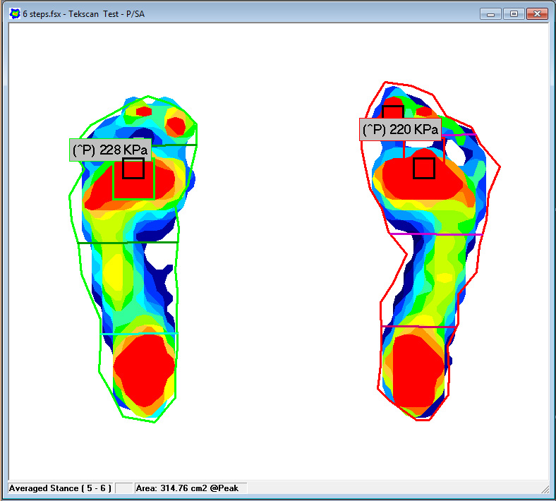 Analyze Foot Function with Pressure Mapping Tekscan